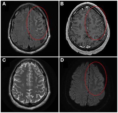 Meningo-cortical manifestations of myelin oligodendrocyte glycoprotein antibody-associated disease: Review of a novel clinico-radiographic spectrum